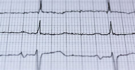 Reading the ECG Heart Monitor Lines - the Complete Guide | UPOlife