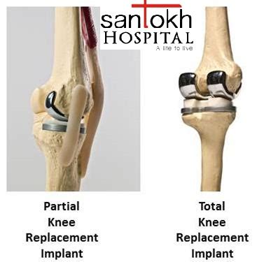 Knee Replacement Surgery Cost by jointreplacements on DeviantArt