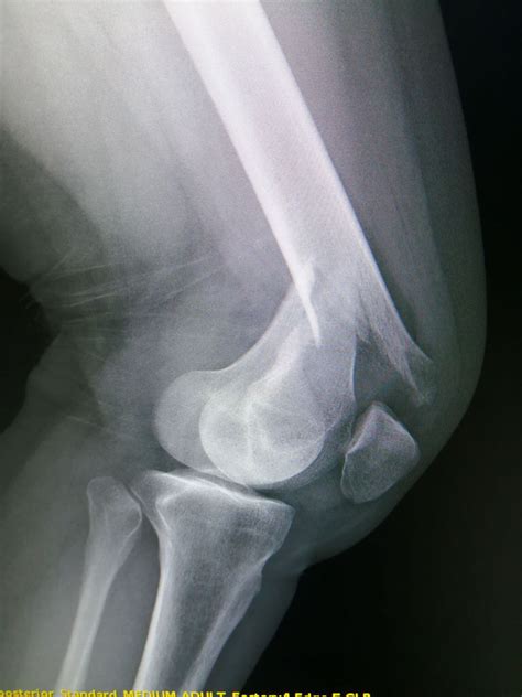 Distal femoral fractures - MEDizzy