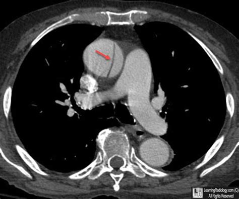 Aortic Dissection X Ray