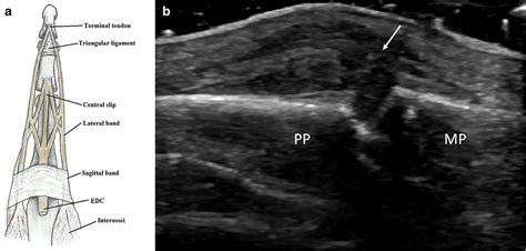 Extensor tendon anatomy and high-grade tear of the extensor tendon at ...