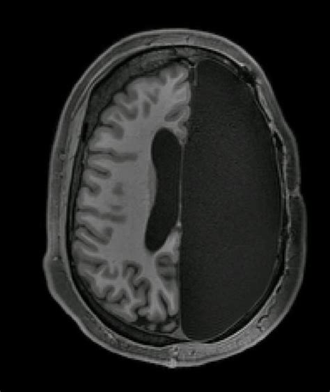 Neuroplasticity in Patients after Hemispherectomy