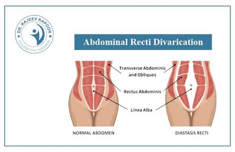 Unveiling the Causes Abdominal Rectus Divarication