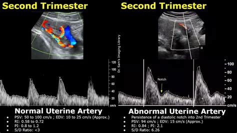 Uterine Artery Spectral Doppler Ultrasound Normal Vs Abnormal Images ...