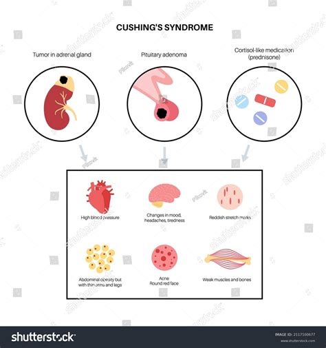 Cushing Syndrome Disease Medical Poster Pituitary Stock Vector (Royalty Free) 2117100677 ...