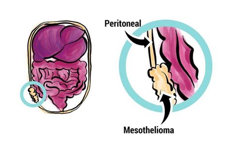 Peritoneal Mesothelioma | Treatment, Prognosis & Diagnosis ...