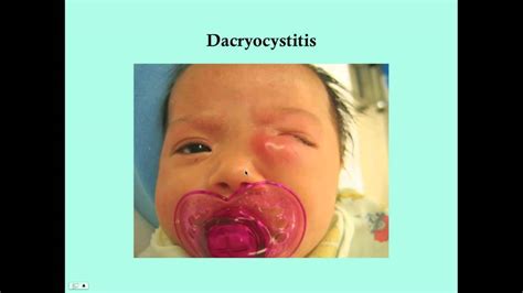 Dacryocystitis - CRASH! Medical Review Series - YouTube