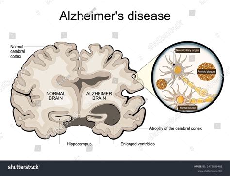 Alzheimers Disease Neurodegeneration Cross Section Alzheimer Stock ...