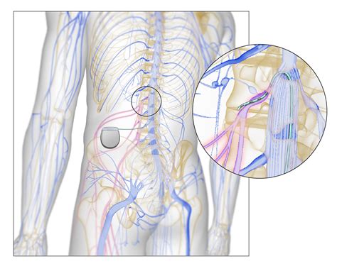 Study to Test Dorsal Root Ganglion Stimulation for Complex Regional Pain Syndrome | Department ...