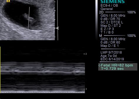 6 Week Ultrasound Heartbeat