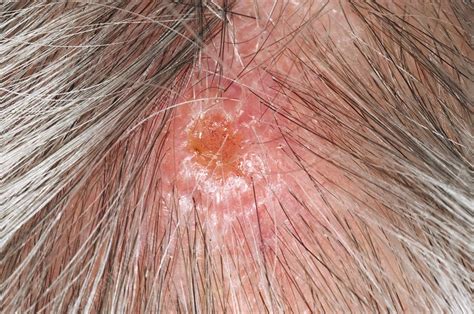 Squamous cell carcinoma of the scalp - Stock Image - C003/3029 - Science Photo Library