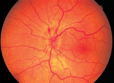 Appearance of Optic Nerve Disorders | Ento Key