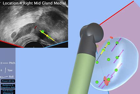 Visualized Prostate Biopsy » The Center for Safety, Simulation ...