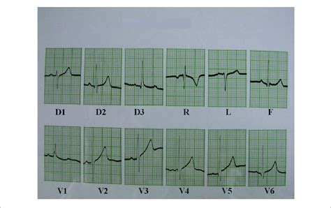 Electrocardiogram showing evidence of mild right ventricular overload. | Download Scientific Diagram