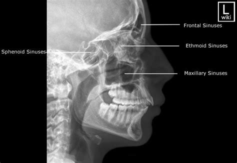 Sinuses Radiographic Anatomy - wikiRadiography | Radiology student ...