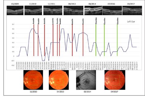 Figure 3 from Long-term results of intravitreal bevacizumab and dexamethasone for the treatment ...