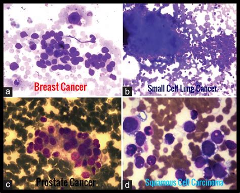 Malignant Infiltration of Bone Marrow | Ask Hematologist | Understand Hematology