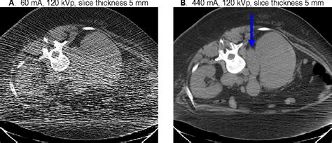 Figure 3 from CT artifacts: Causes and reduction techniques - Semantic ...