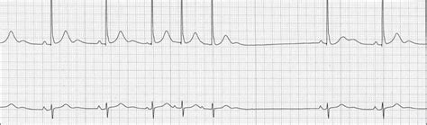 Premature Ventricular Contractions Causes