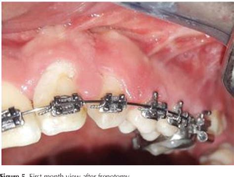 Figure 5 from Frenotomy procedure of a cleft lip and palate case | Semantic Scholar