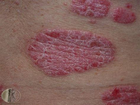 Common skin rashes and what to do about them