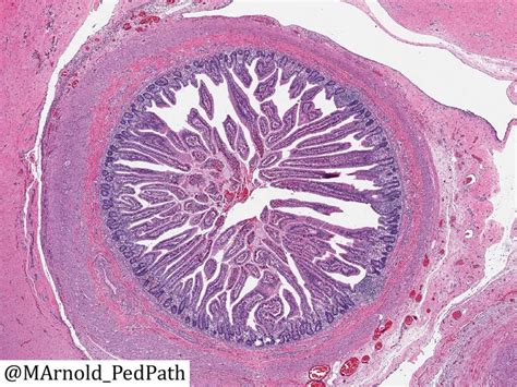 USCAP - Abnormal umbilicus: Omphalomesenteric duct. Origin...