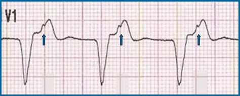 The Basics of Paced Rhythms - ECG Medical Training