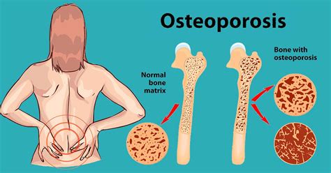 Osteoporosis Treatment: 13 Ways To Stop Bone Loss Before It's Too Late!