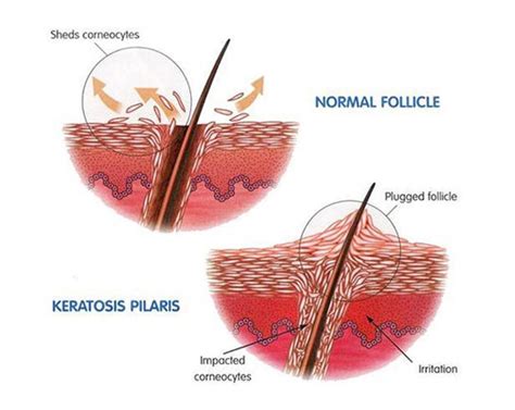 Treatment for Keratosis Pilaris