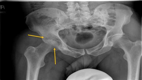 X Ray Pictures Of Hip Arthritis