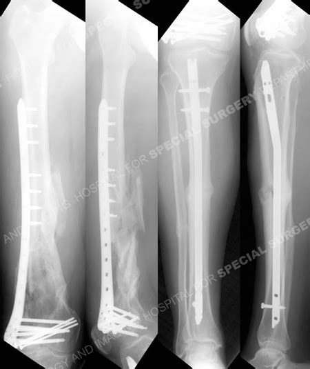 Compound Fracture | Open Fracture | HSS Orthopedic Trauma Service