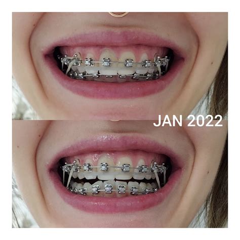 Braces Progress : r/braces