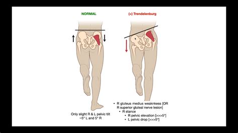 Trendelenburg Sign EXPLAINED - YouTube