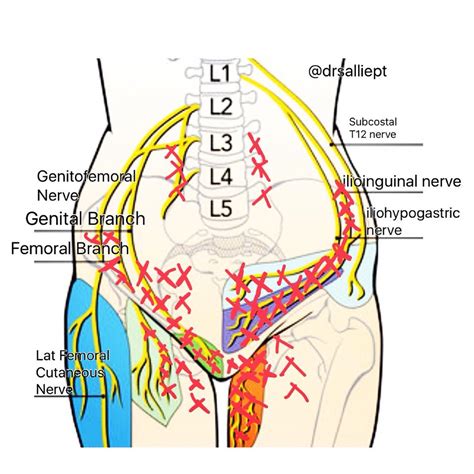 Iliohypogastric Nerve Pain