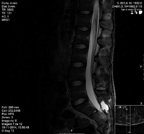 Lumbosacral MRI demonstrating post-traumatic meningocele in sagittal view. | Download Scientific ...