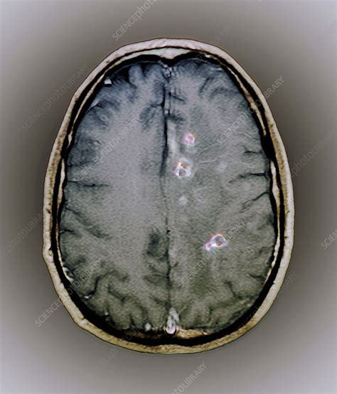 Tapeworm cysts in the brain, MRI scan - Stock Image - F003/9159 - Science Photo Library