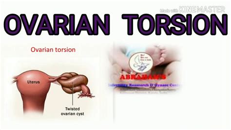 Ovarian Torsion - YouTube