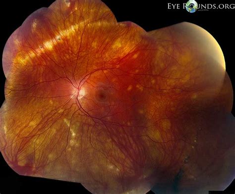 Multifocal choroiditis and panuveitis (MCP)