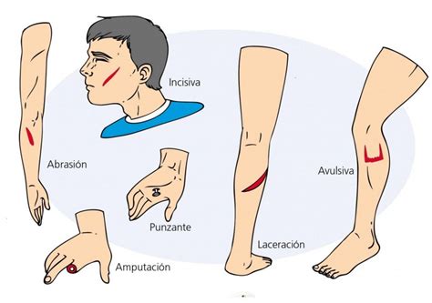 Manejo De Heridas UPAEP