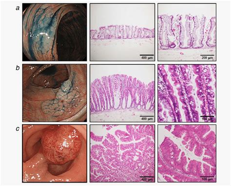 Hyperplastic Polyp Sawtooth