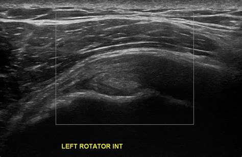 Shoulder Ultrasound Diagnostic Imaging - Melbourne Radiology