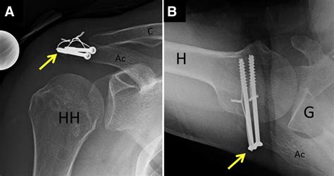 Operative Treatment of Symptomatic Meso-Type Os Acromiale - Arthroscopy Techniques