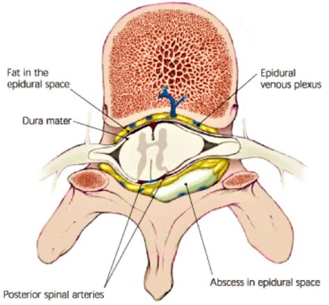 Epidural abscess causes, symptoms, diagnosis, treatment & prognosis