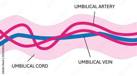 anatomy of umbilical cord. two umbilical veins and one umbilical artery ...