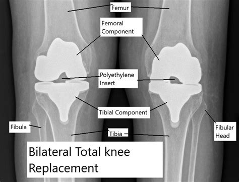 Bilateral Knee Replacement (Simultaneous) - Complete Orthopedics