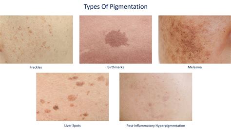 Get Rid Of Hyperpigmentation With Home Remedies | Dream Plastic Surgery