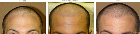 Before and After Picutres | ARTAS – Trasplante Robotizado de Pelo