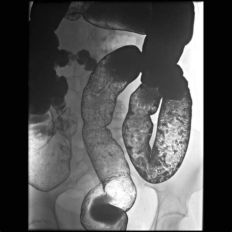 Inflammatory pseudopolyps | Radiology Case | Radiopaedia.org Ulcerative ...