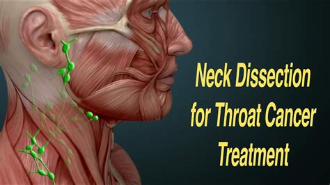 Neck Dissection Surgery for Throat Cancer Treatment (MRND, RND) - YouTube