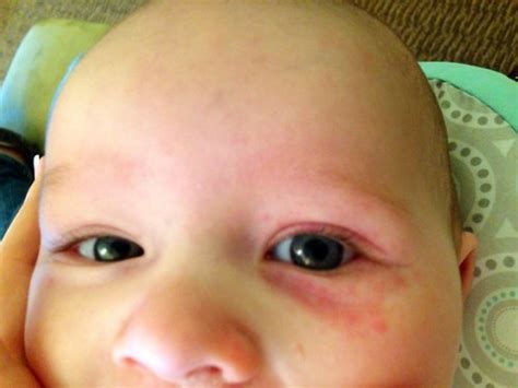 Opinions please- Redness around lo's eye... Changing pediatricians | BabyCenter